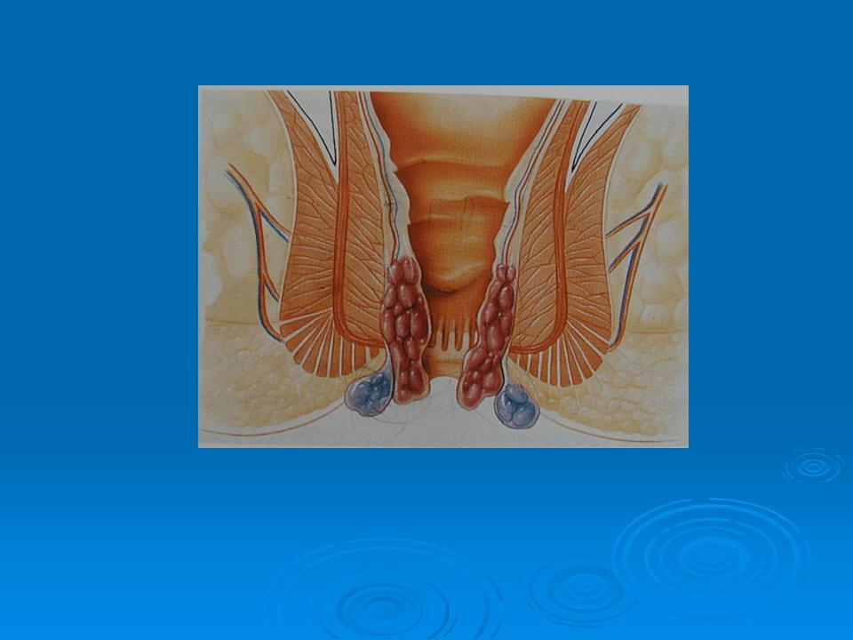 Dr Tsagkatakis Creta Hemorrhoidectomy longo images