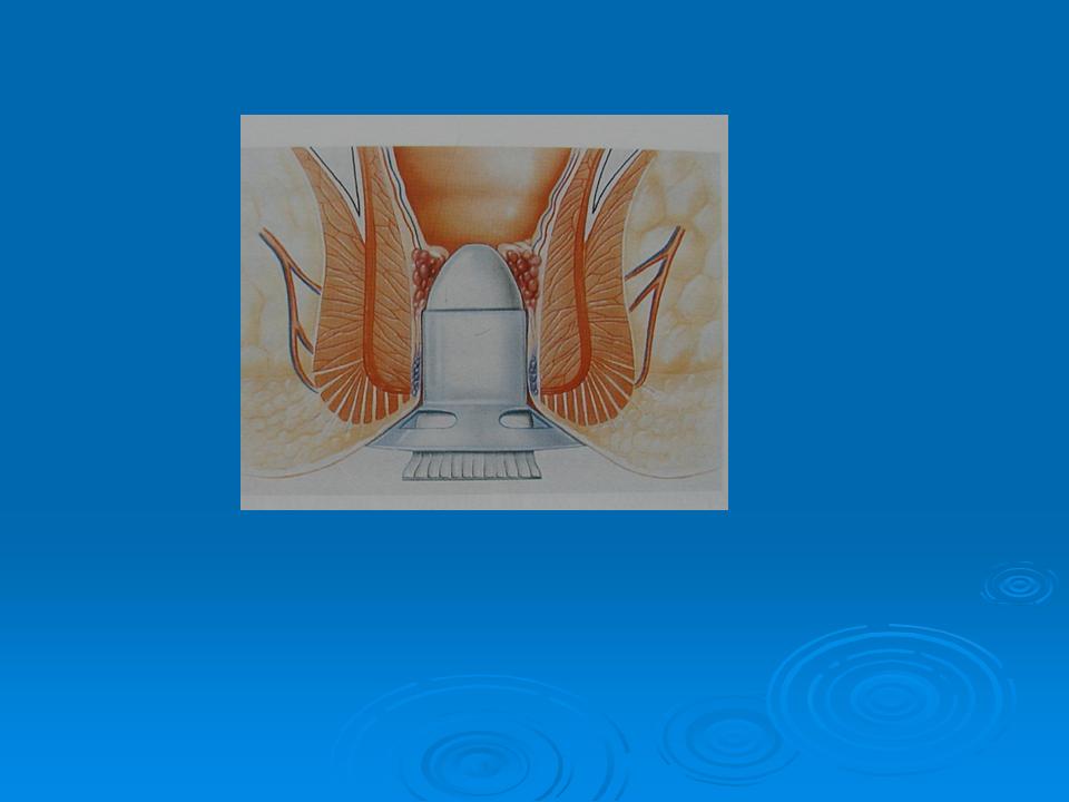 Dr Tsagkatakis Creta Hemorrhoidectomy longo images