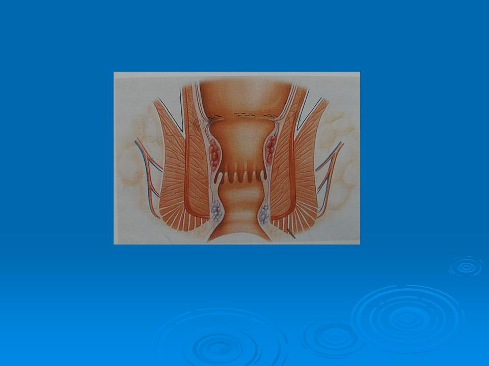 Dr Tsagkatakis Creta Hemorrhoidectomy longo images