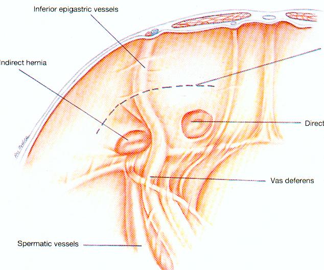 Dr Tsagkatakis laparoscopic-inguinal