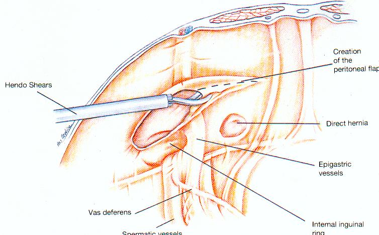 Dr Tsagkatakis laparoscopic-inguinal