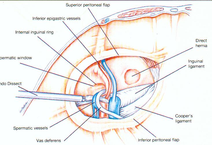 Dr Tsagkatakis laparoscopic-inguinal