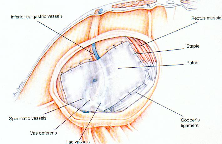 Dr Tsagkatakis laparoscopic-inguinal